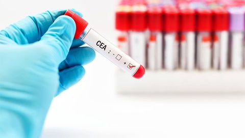 Détecter le cancer de la prostate